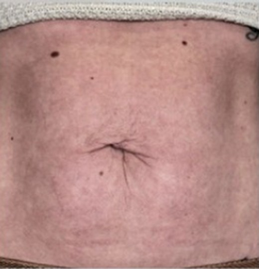 Abdominal skin laxity, after
