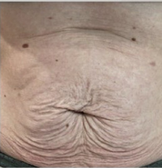 Abdominal skin laxity, before