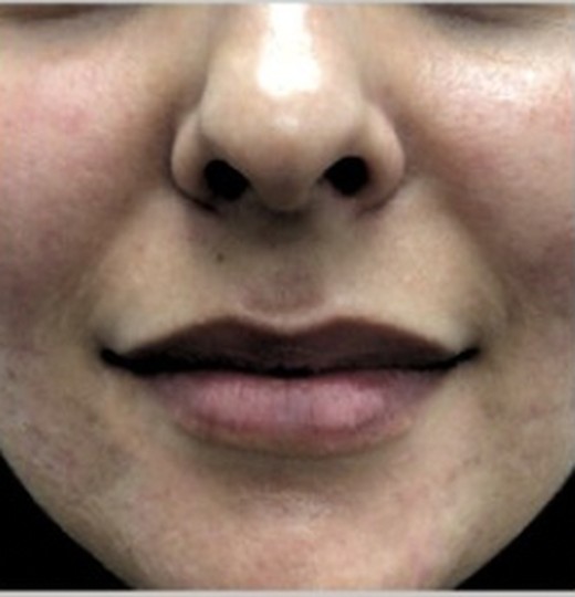 Mid-face texture and pigmentation, after