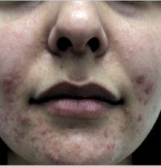 Mid-face texture and pigmentation, before